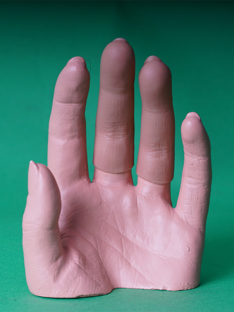 Prothèse esthétique de doigt 3
